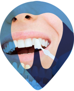 DENTISTICA
A dentística é a área da odontologia que atua sobre os dentes para conquistar a harmonização do sorriso. São utilizadas técnicas que  influenciam na alteração do formato dos dentes, seja no tamanho, no alinhamento ou clareando (como o Clareamento Dental).