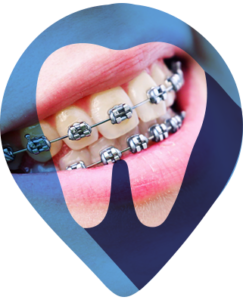 ORTO
A função principal do tratamento ortodôntico é restabelecer a oclusão dentária (perfeito alinhamento dos dentes superiores com os inferiores), que é fundamental para a correta mastigação e, consequentemente, a adequada nutrição e saúde bucal.